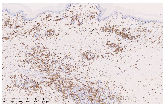 Immunohistochemistry showed positive staining for CD56 of atypical cells (100x).